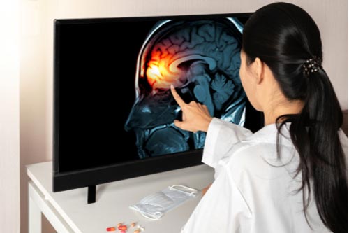 Macon brain injury lawyer concept, doctor showing scan of brain injury